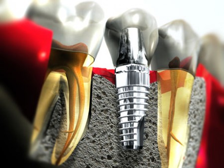 Mundhygiene bei Brücken und Implantaten