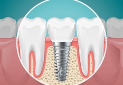 Implantologie Zahnimplantate
