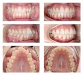 Ortodontsko zdravljenje s fiksnim zobnim aparatom